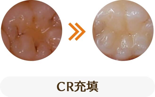 虫歯