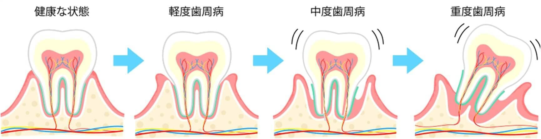 歯肉炎
