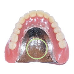 チタン床義歯